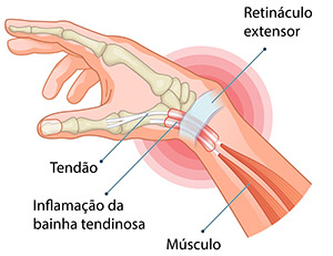 Síndrome de Quervain