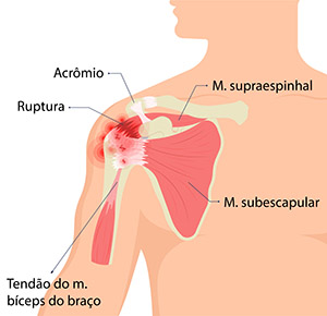 Ruptura do m. supraespinhal