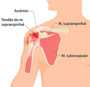 Tendinite no tendão do m. supraespinhal